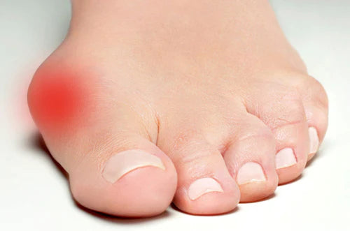 Schoenen bij Hallux Valgus pijn